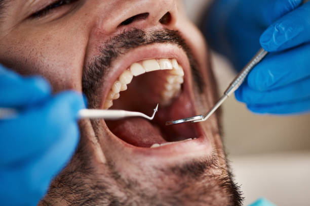 Best Emergency Wisdom Teeth Removal in Beeville, TX